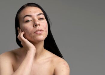 Akné: nepříjemné onemocnění, které trápí nejen dospívající