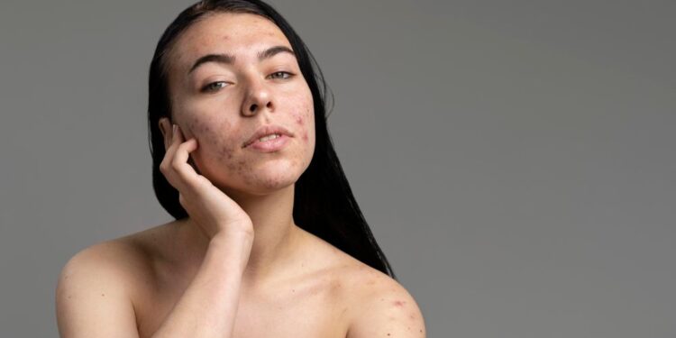 Akné: nepříjemné onemocnění, které trápí nejen dospívající